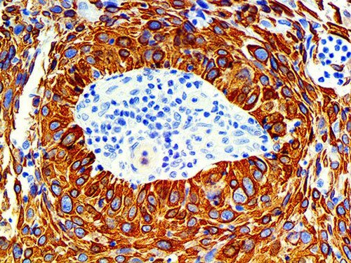 IHC of Cytokeratin 14 Rmab on an FFPE Cervical Tissue